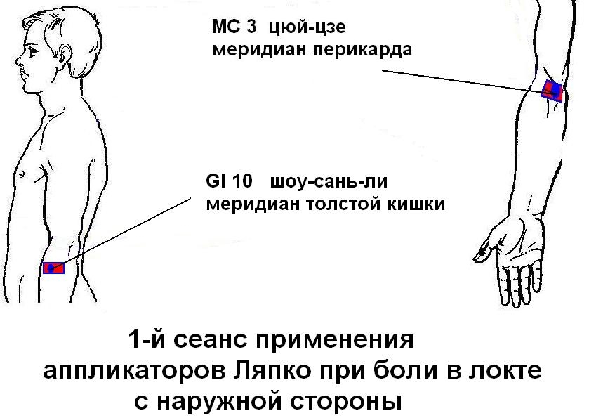 Болит внешняя сторона. Цюй Цзе. Болит локоть с наружной стороны. Меридиан перикарда точка Цюй-Цзе. Боль в локте с внешней стороны.