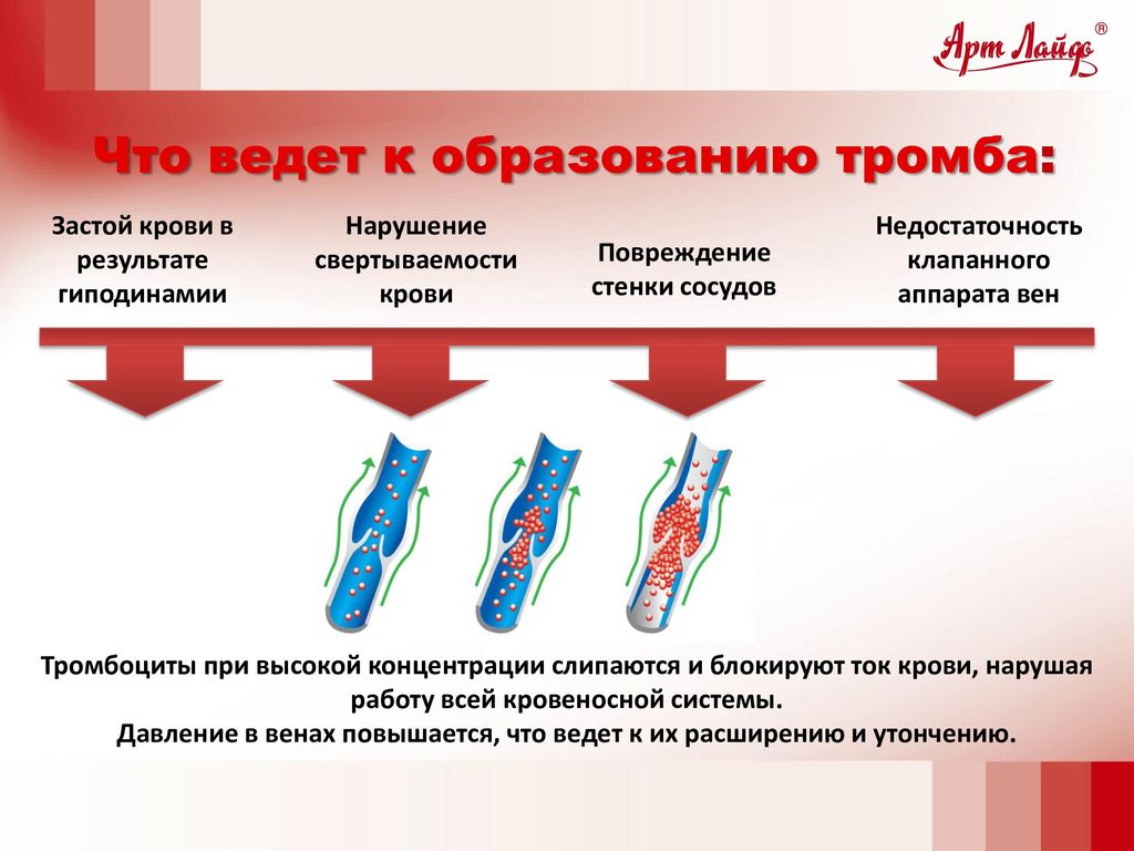 Причины возникновения тромбоза. Этапы образования тромбоза. Профилактика тромбозов артерий. При образовании тромба.