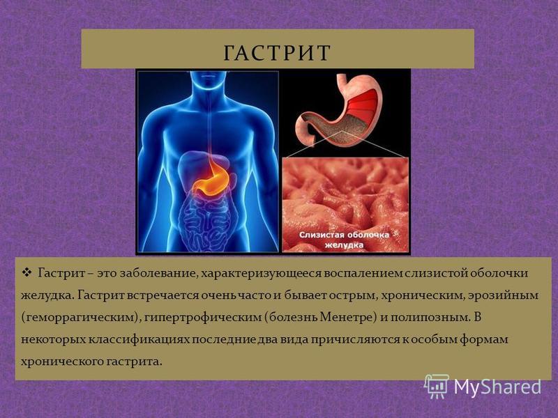 Лечение гастрита презентация