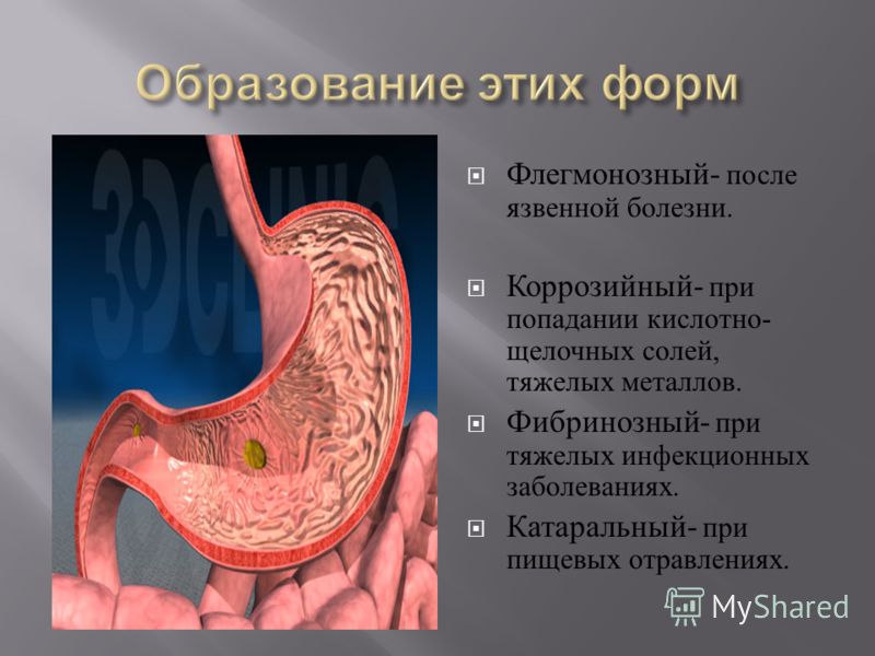 Симптомы желудка. Фибринозный острый гастрит. Острый флегмонозный гастрит. Острый Гнойный гастрит.