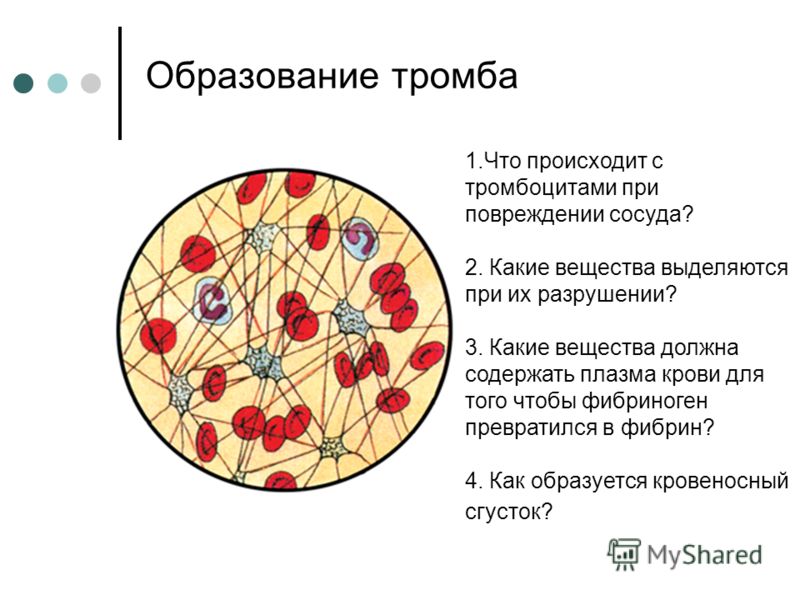 Схема образования сгустка в просвете сосуда