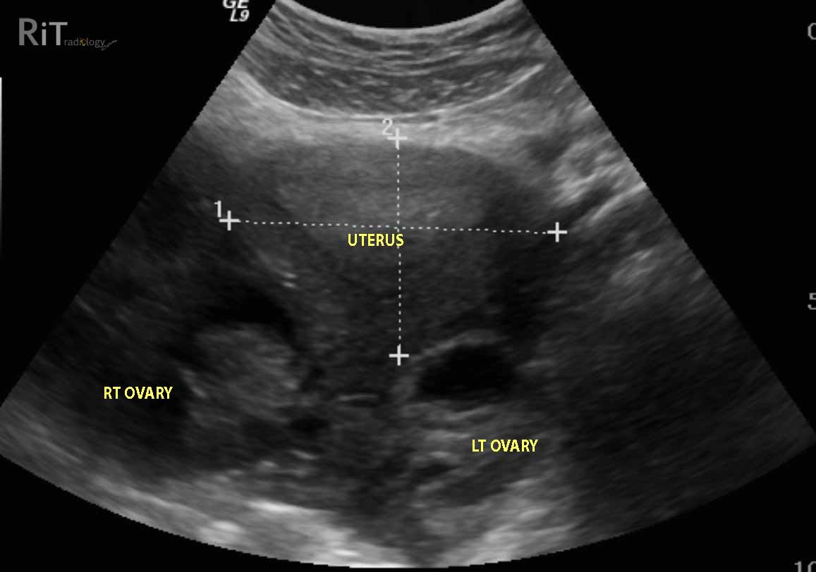 Что значит яичники. УЗИ расположение яичников. Расположение матки и яичников на УЗИ. УЗИ яичников у женщин фото. Расположение яичников у женщин на УЗИ.