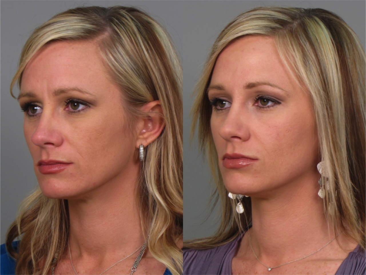 Фото до и после укола ботокса