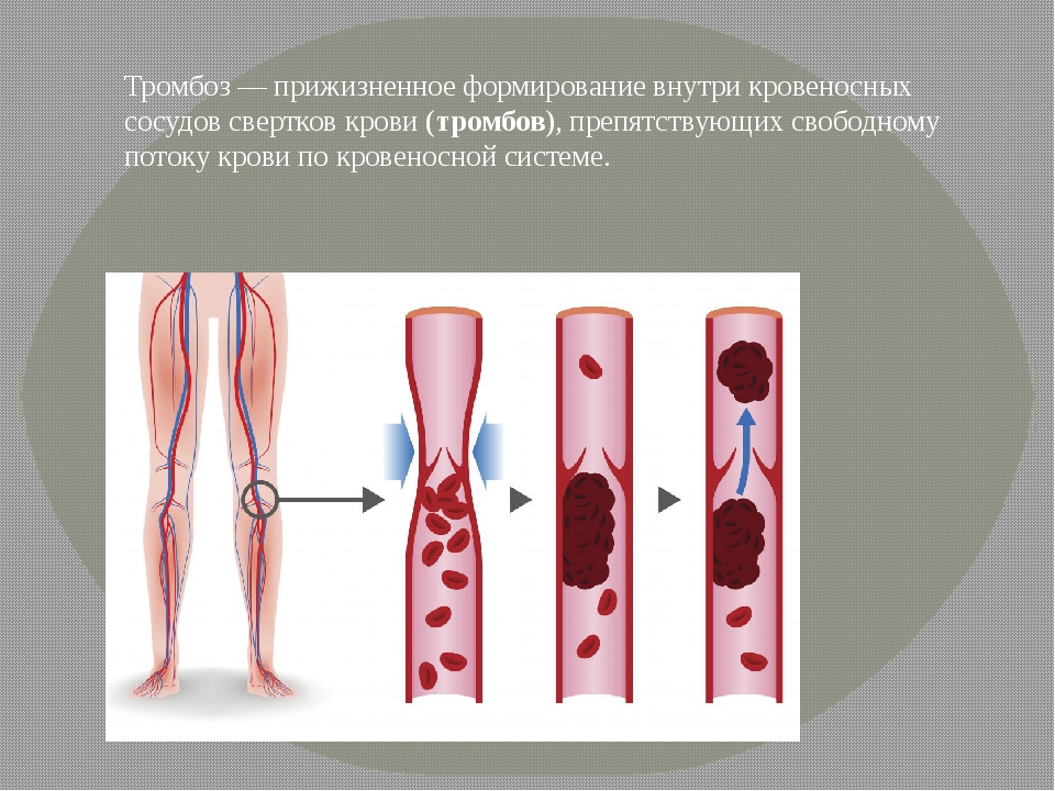 Тромбоз артерия и вена. Тромбоз венозных сосудов. Тромбоз, тромбофлебит, тромбоэмболии. Тромбофлебит кровеносного сосуда. Тромбоэмболия кровеносного сосуда.