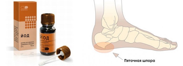 Лечение пяточной. Средство от шпор на ступне. Средство от шпоры на пятках.