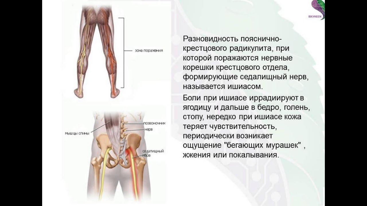 Радикулопатия пояснично крестцового. Пояснично-крестцовой радикулопатии. При пояснично. Крестцовый. Радикулит. Радикулит крестцового отдела. Клинические симптомы радикулита.