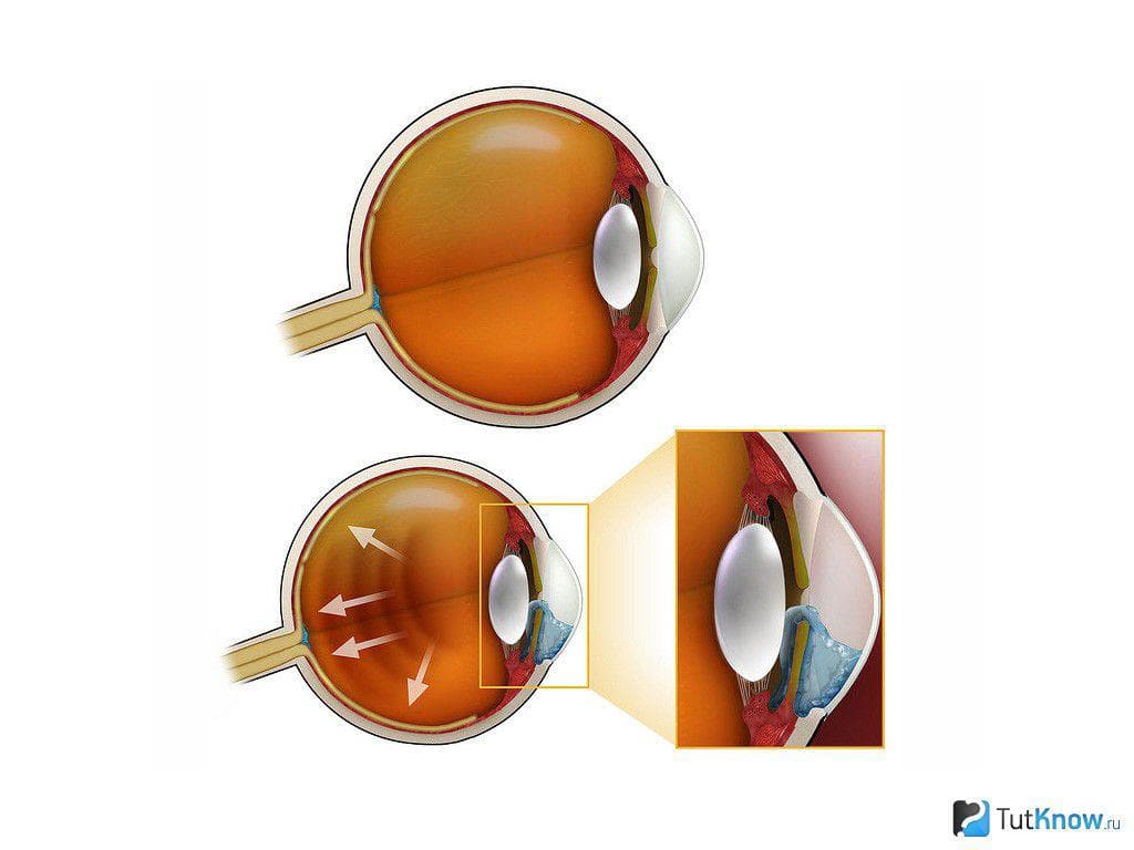 Глазное давление при катаракте. Профилактика глаукомы глаза. Глаукома начальная стадия. Массажер для глаз при глаукоме.