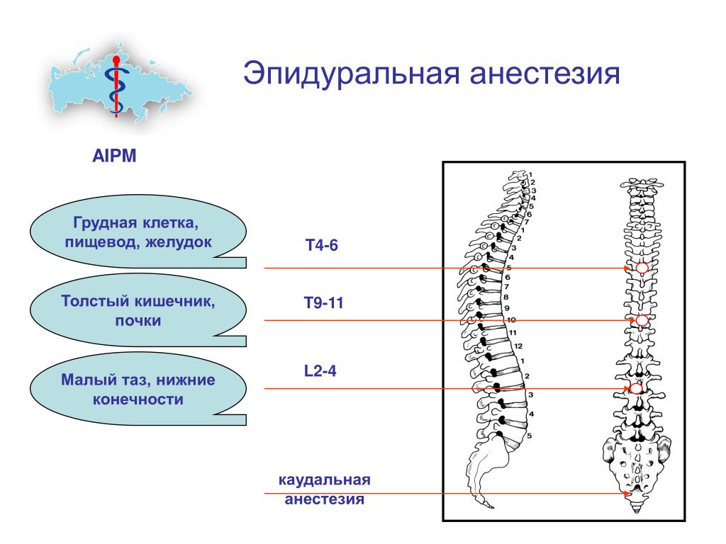 Схема эпидуральной анестезии