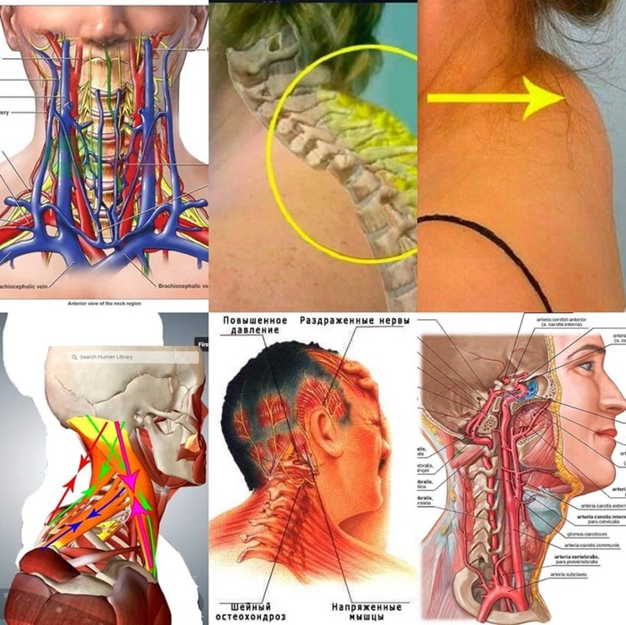 Остеохондроз шейный нерв. Заземления нервов в шеи. Защемление шейного нерва.