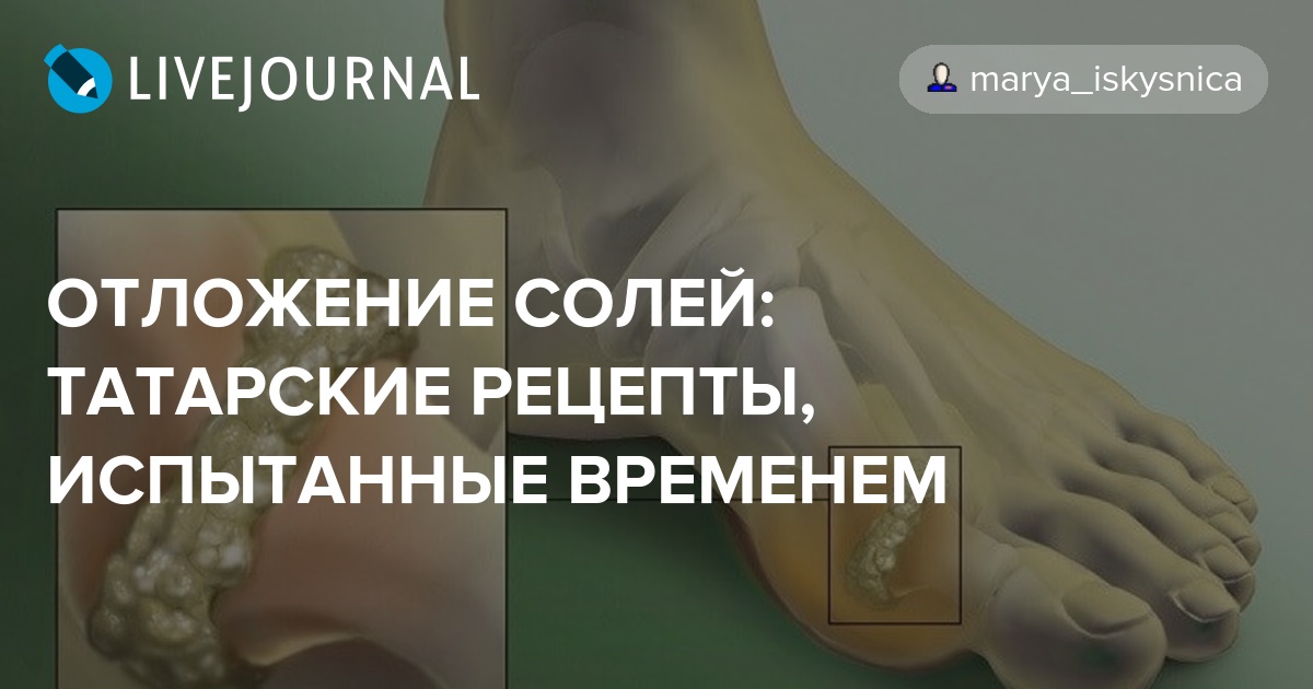 Отложение солей. Отложение солей в суставах. Как лечить отложение солей. Отложение солей название. Соли кальция в суставах.