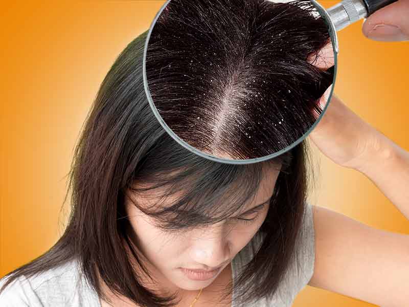 Как вылечить волосы от перхоти в домашних условиях быстро