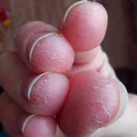 Причины сухости кожи и трещин на пальцах рук
