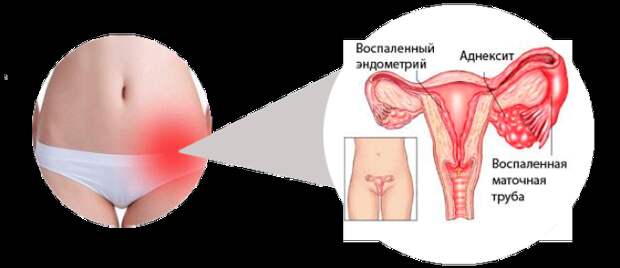 Что такое придатки у женщин и где они находятся фото