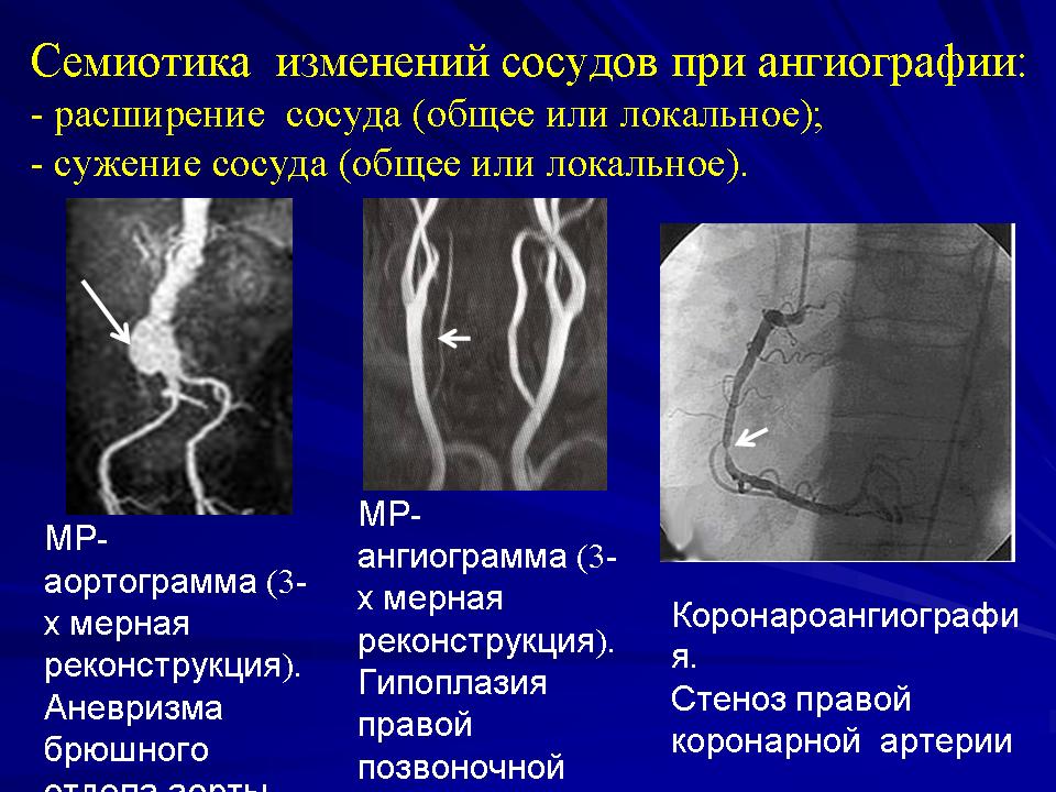 Гипоплазия правой позвоночной артерии что это