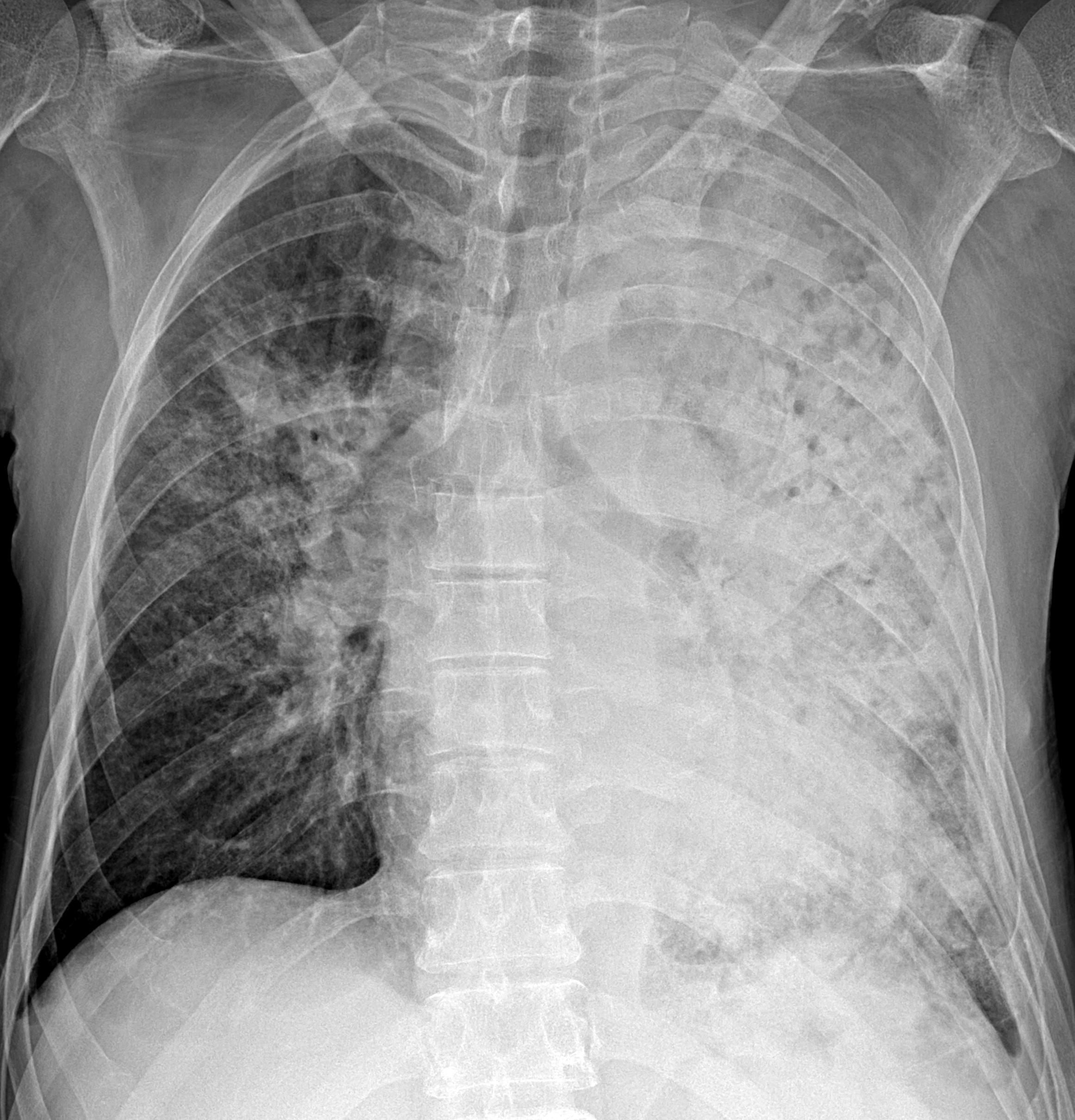 Коронавирус пневмония рентген