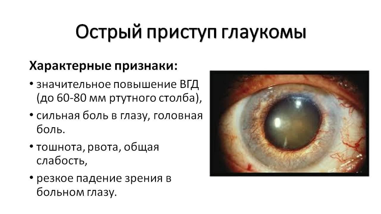 Глаза давление сильное. Симптомы острого приступа закрытоугольной глаукомы. При остром приступе глаукомы зрачок. Приступ открытоугольной глаукомы симптомы. При остром приступе закрытоугольной глаукомы зрачок:.