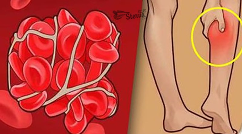 Как проверить есть ли в организме тромбы. Симптомы образования тромба в ноге. Образование тромба на ступне.