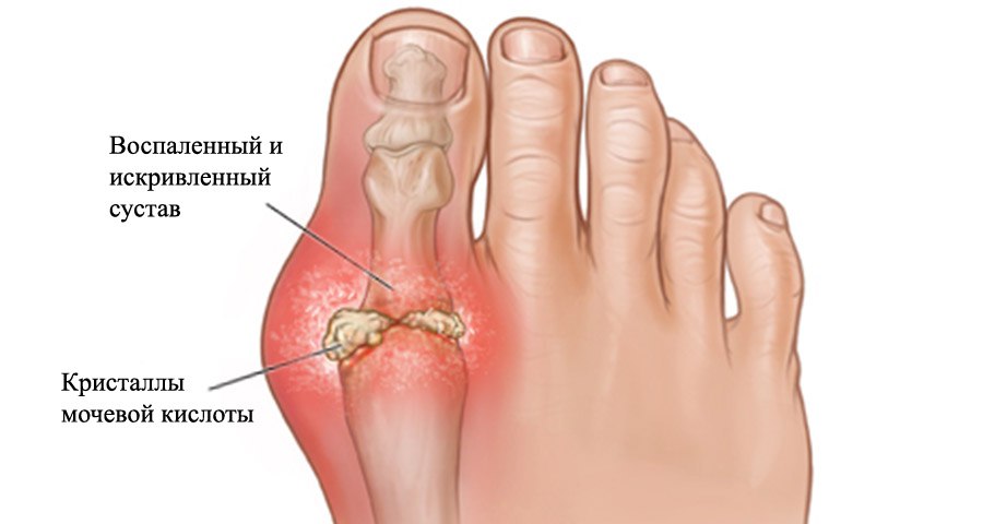Соли в суставах