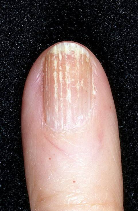 Полоски на ногтях причины вертикальные у женщин. Лейконихия продольная. Поперечные полосы на ногтях. Продольные полоски на ногтях. Продольные белые полоски на ногтях.