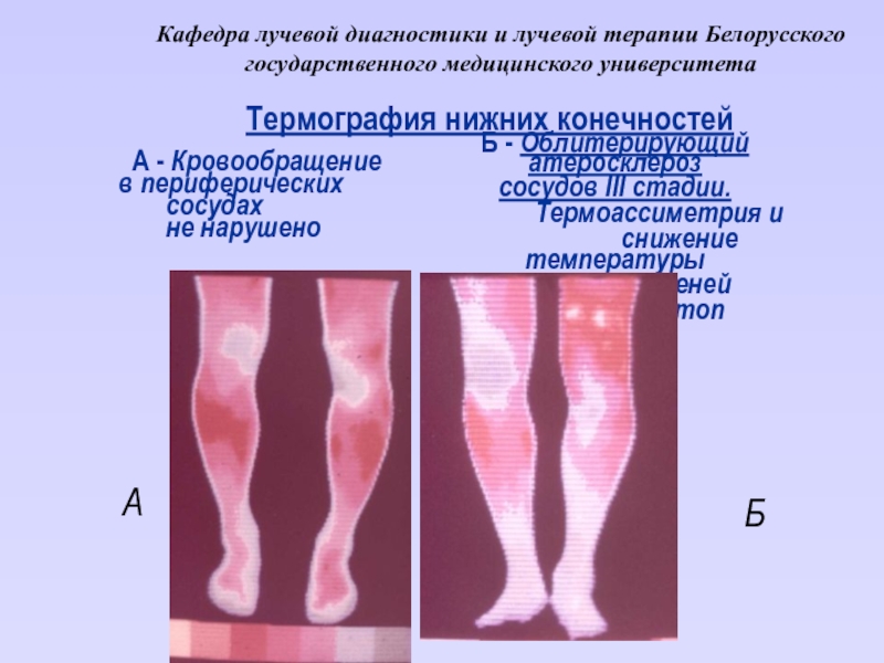 Инвалидность при атеросклерозе. Облитерация сосудов нижних конечностей. Облитерирующий атеросклероз сосудов конечностей. Атеросклеротическое поражение сосудов нижних конечностей. Облитерирующий атеросклероз сосудов ног.