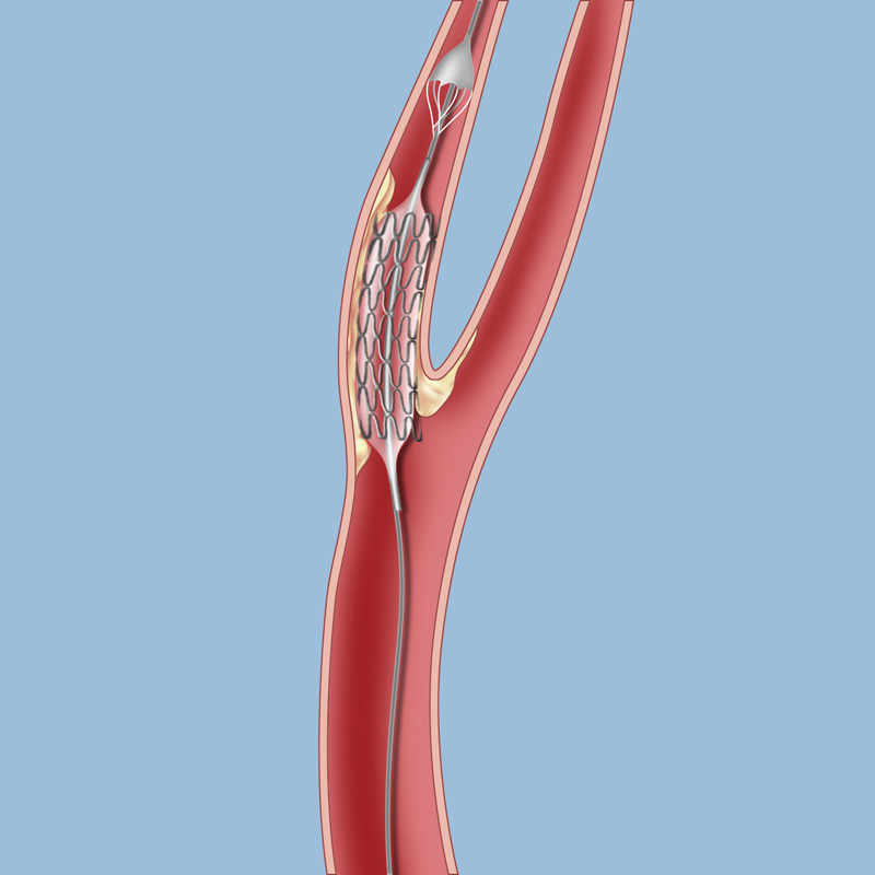 Баллонная ангиопластика нижних конечностей. Эндоваскулярная стентирование. Эндоваскулярная баллонная ангиопластика. Ангиопластика сонной артерии. Эндоваскулярное стентирование сонной артерии.