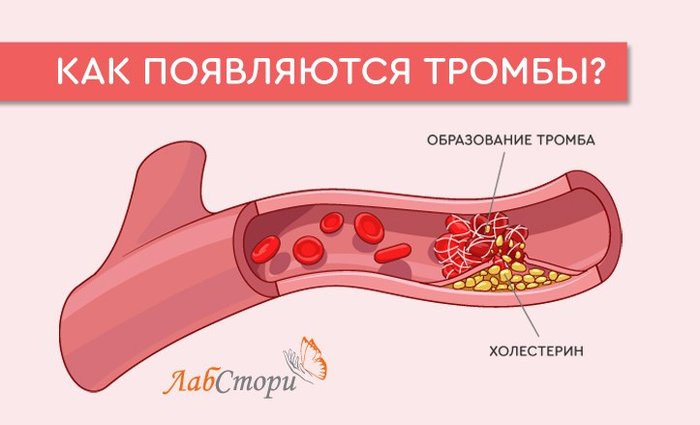 Коронавирус тромбы. Образование тромбов в артериях.