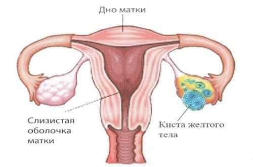 Где находится матка фото. Киста яичника во влагалище. Киста в женском организме. Киста жёлтого тела задержка месячных.