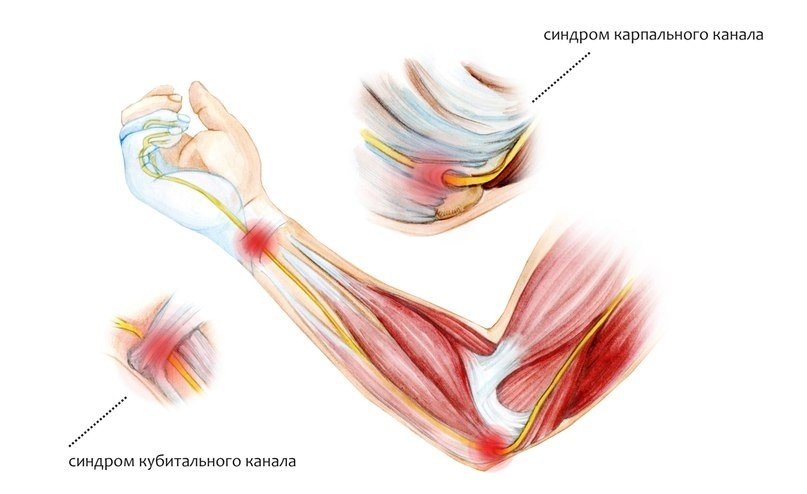 Локтевой сустав мышцы и сухожилия. Туннельный синдром локтевого нерва на кисти. Кубитальный туннельный синдром локтевого нерва. Кубитальный канал локтевого сустава. Запястный синдром компрессии локтевого нерва.