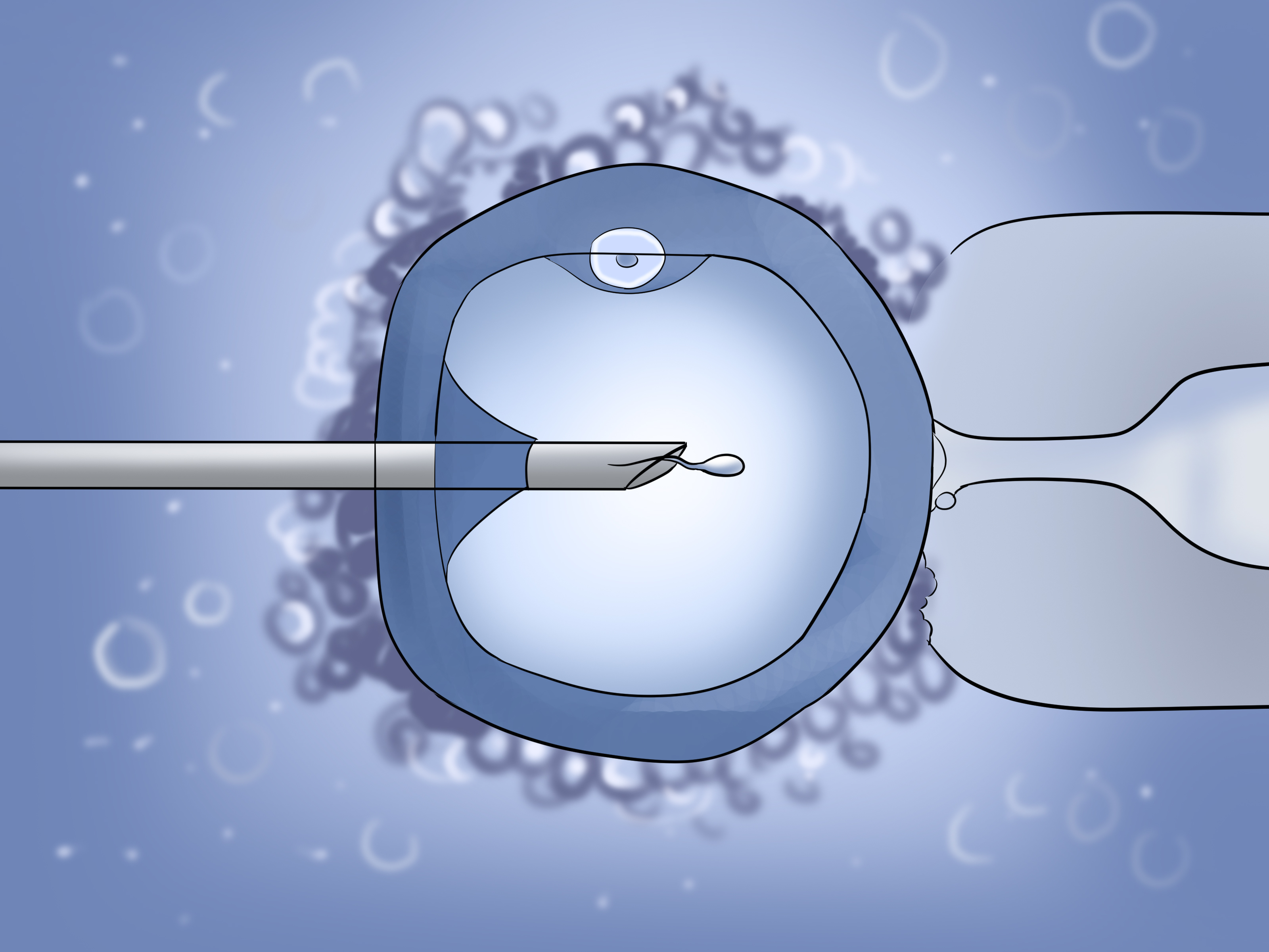 Метод эко. Интрацитоплазматическая инъекция сперматозоидов (ИКСИ). Экстракорпоральное оплодотворение ИКСИ. ИКСИ оплодотворение что это. Метод ИКСИ.