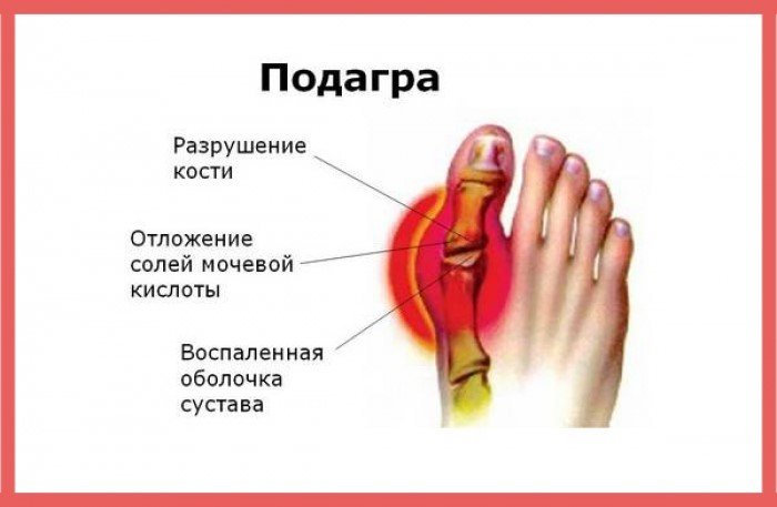 Отложение солей. Отложение солей на большом пальце ноги. Воспаление на пальце называется.